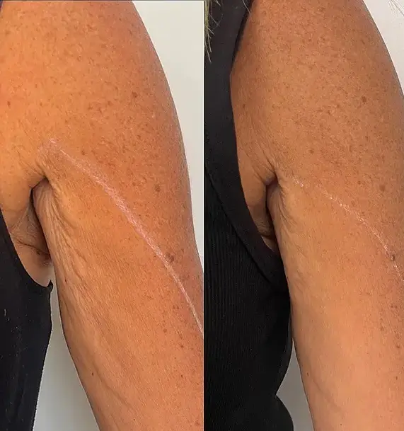Radiofrecuencia en brazos - Bioestimulación